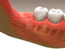 Extractions1