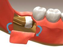 Extractions2