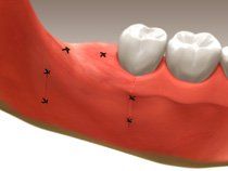 Extractions3