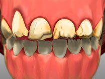 Full Mouth Restoration1