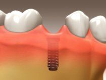 Implant Restoration2