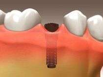 Implant Restoration3