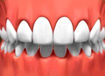 Porcelain Veneers3